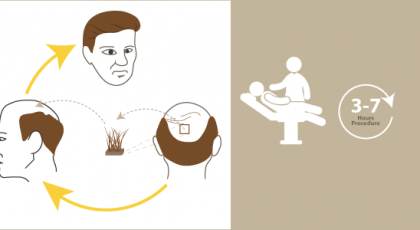 hair-transplant-result